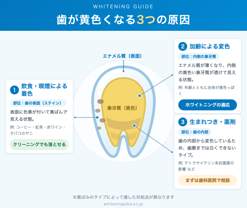 歯の断面図で見る歯が黄色くなる3つの原因（表面につく着色ステイン／加齢でエナメル質が薄くなり内側の黄色い象牙質が透ける変色／生まれつき・テトラサイクリン系薬剤による内部の変色）